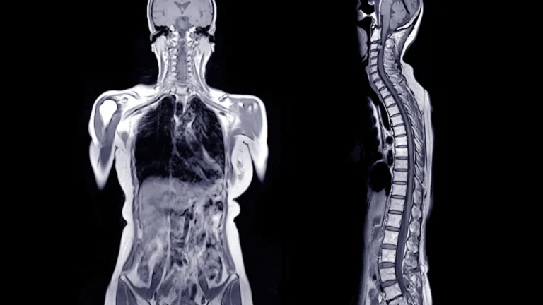 Ele comeu um hambúrguer e morreu horas depois. Médicos descobriram uma causa chocante.