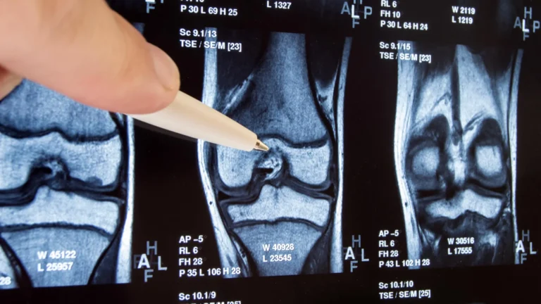 Cirurgia comum no joelho considerada ineficaz, pode piorar a situação