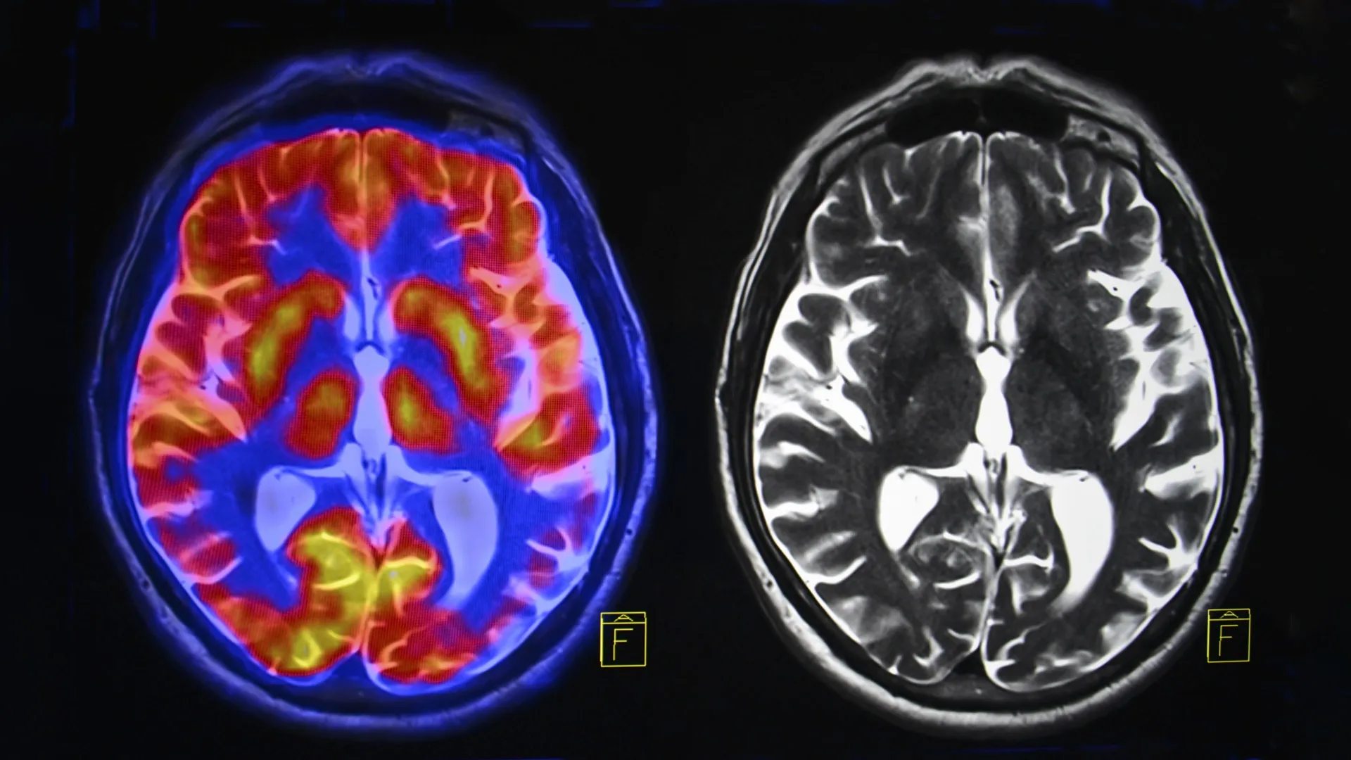 Imagens cerebrais revelam dois tipos distintos de autismo