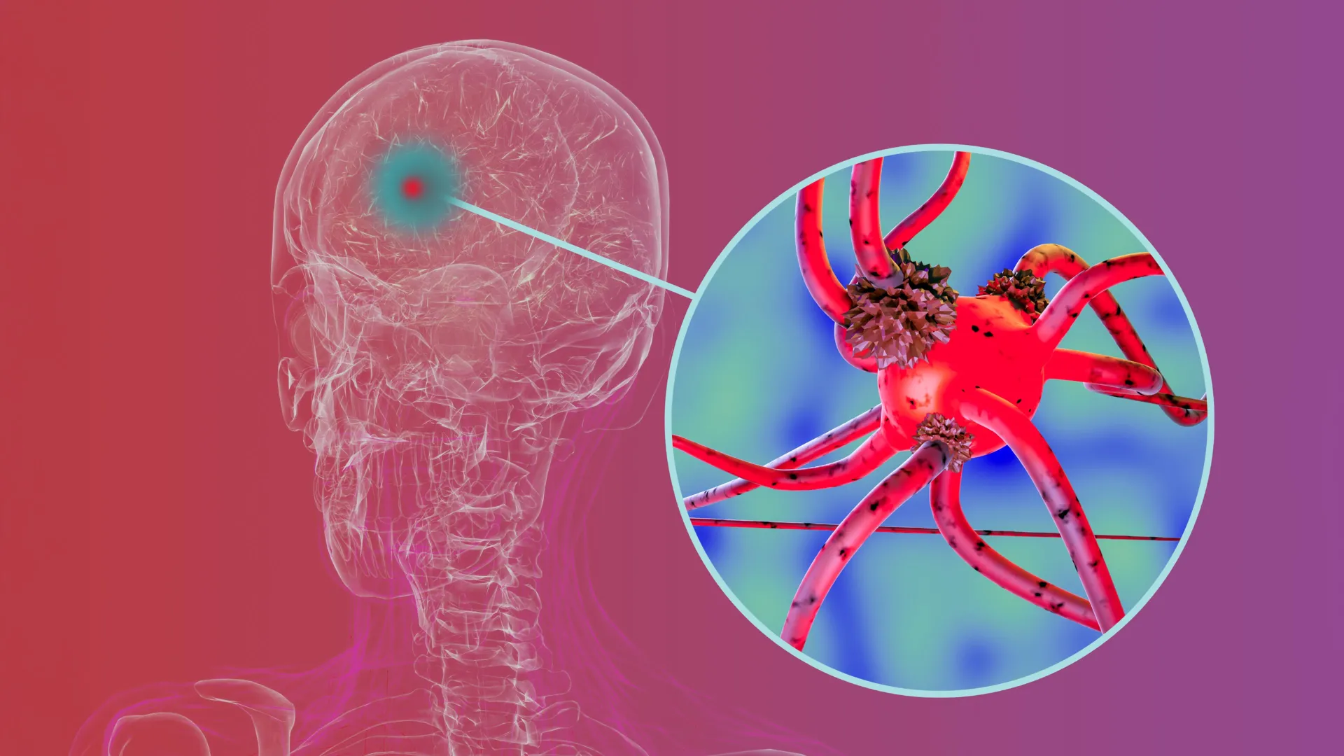 Proteína chave ajuda a disseminação do Parkinson pelo cérebro