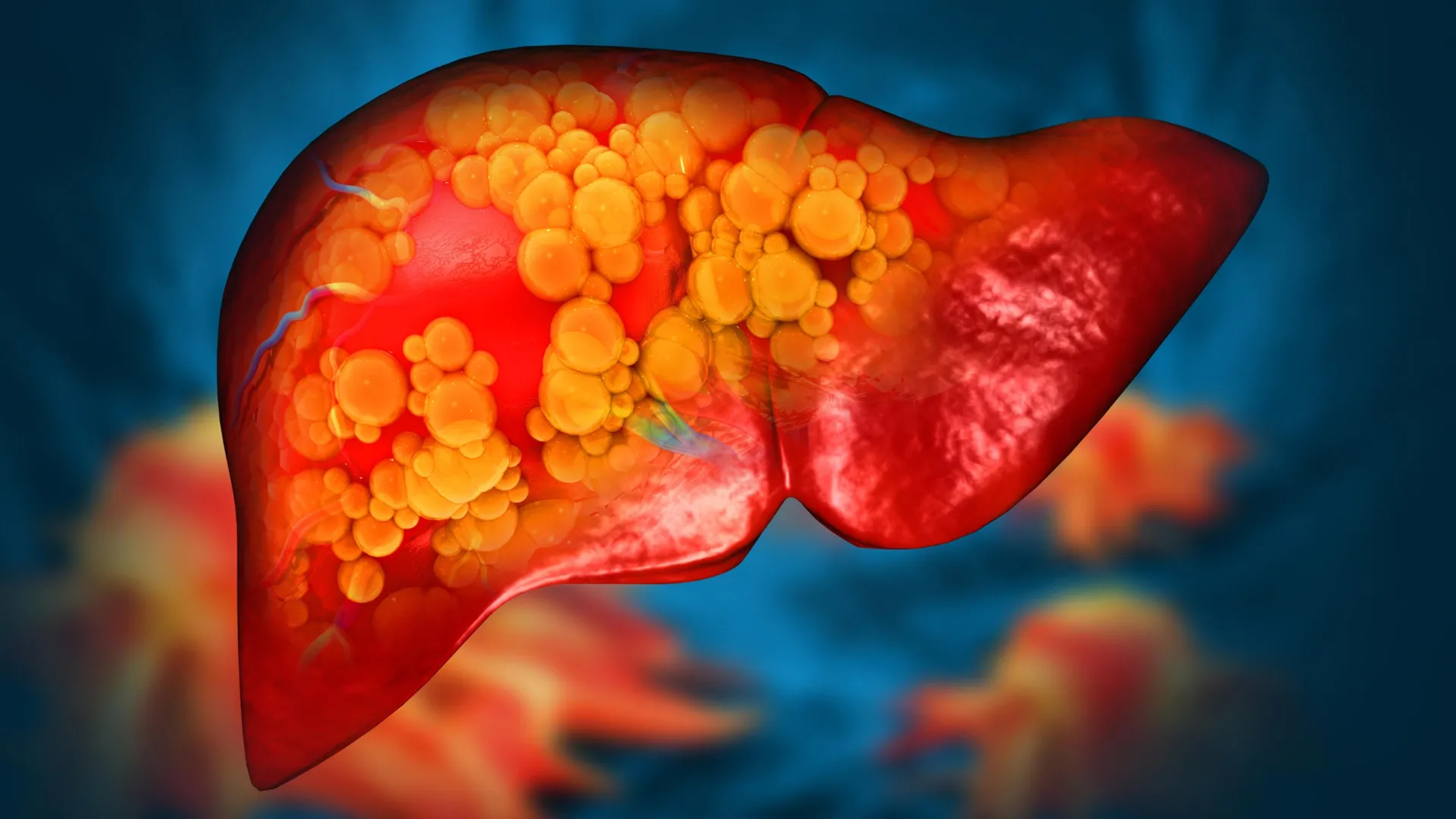 Novo medicamento pode finalmente parar a doença hepática gordurosa fatal